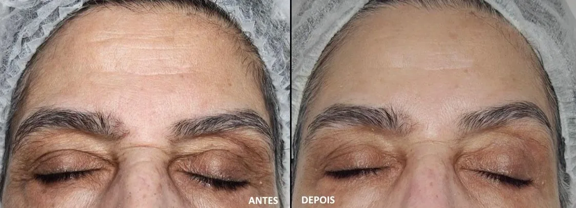 Peeling Clareador